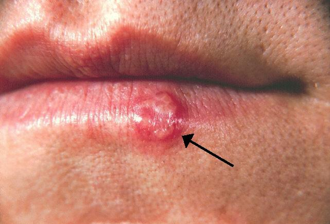herpes_simplex