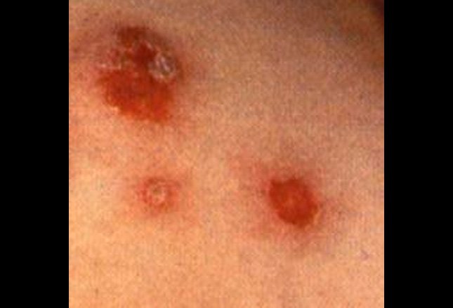impetigo