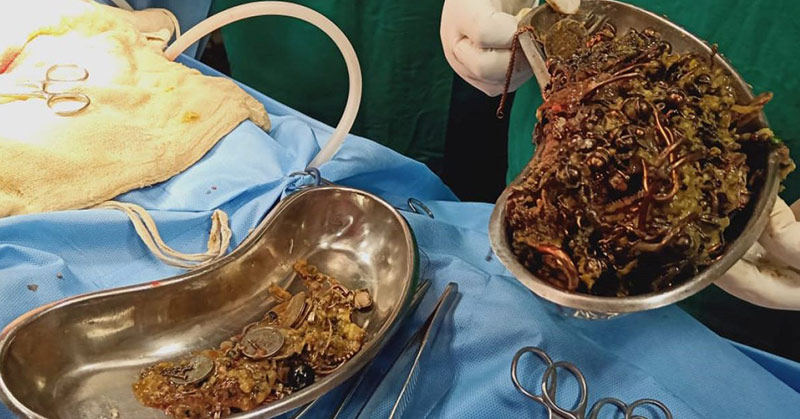 Doctors Found Over $64,000 of Jewelry in Woman’s Stomach