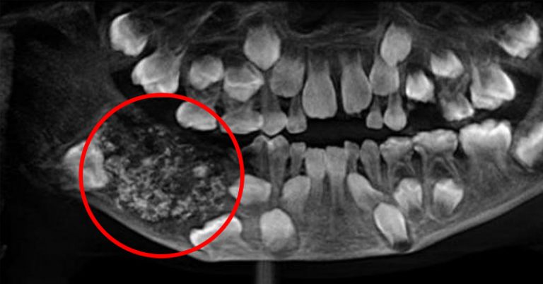 Surgeon Extracts More Than 500 Teeth from a 7-Year Old - Featured image