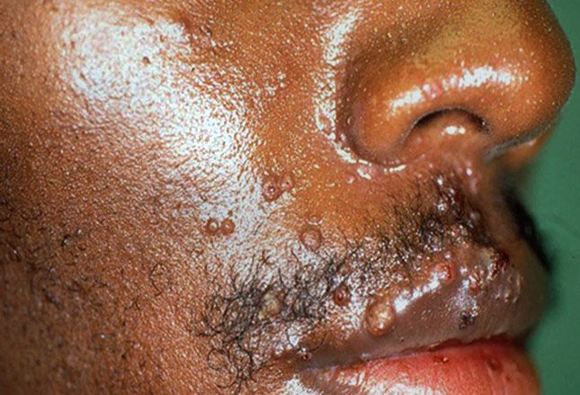 molluscum contagiosum