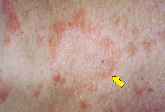 pityriasis rosea
