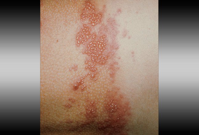 shingles