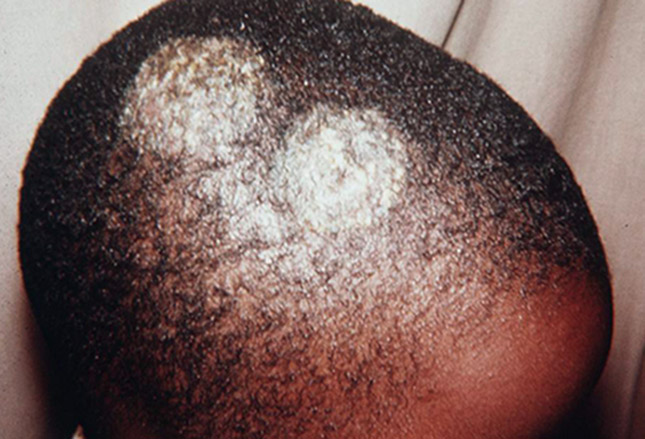 tinea capitis