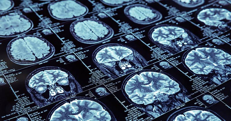 Memory Loss from Alzheimer’s Reversed by Head Device Using Electromagnetic Waves