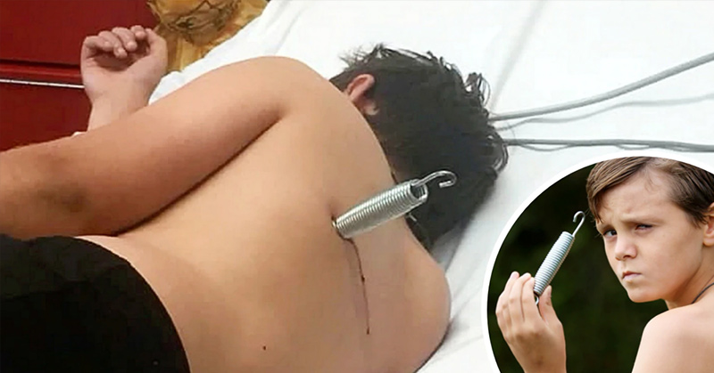 Freak Accident on A Trampoline Left 12-Year-Old British Boy with A Spring Buried 6cm in His Back