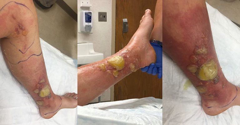 Woman Suffers Second Degree Chemical Burn from Wild Parsnip - Featured image