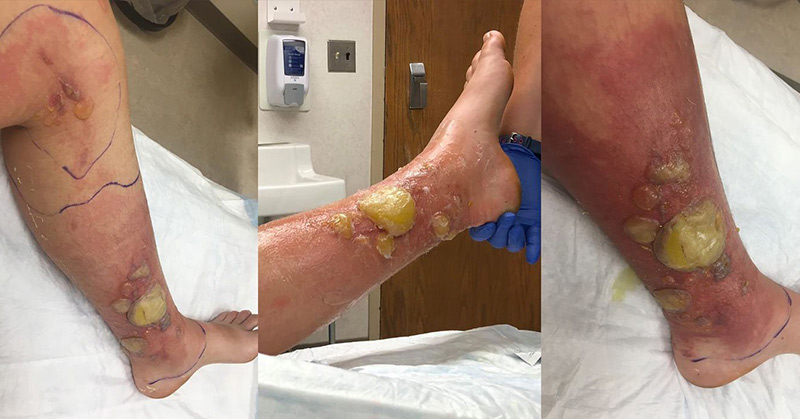 Woman Suffers Second Degree Chemical Burn from Wild Parsnip