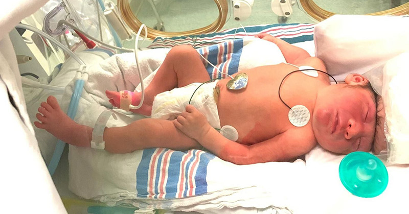 Baby Born with ‘Brain Outside of Skull’ Believed to be the First Survivor of Exencephaly Diagnosis