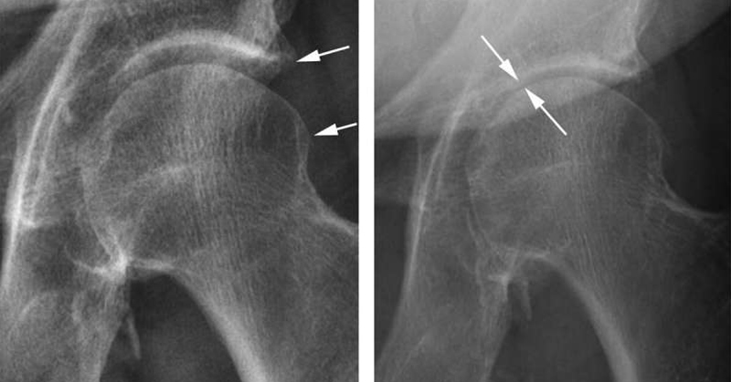 Research Shows Corticosteroid Injections May Do More Damage Than Previously Thought - Featured image