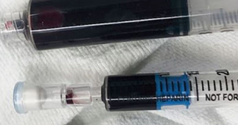 Women Turns Blue From Tooth-Numbing Medication