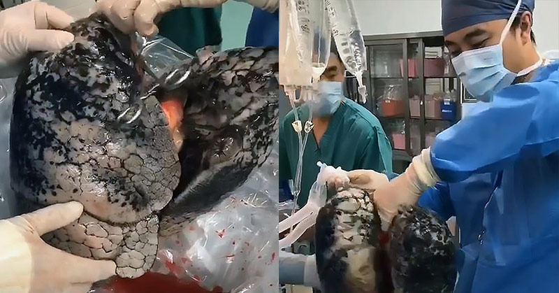 Shocking Video Showing Lungs of 52-Year-Old Chain Smoker. ‘The Best Anti-Smoking Add Ever’
