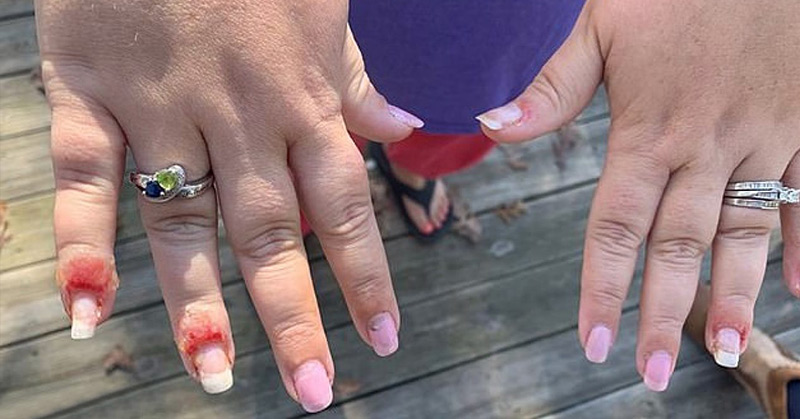 Woman left with fungal infection and bloody, swollen fingers
