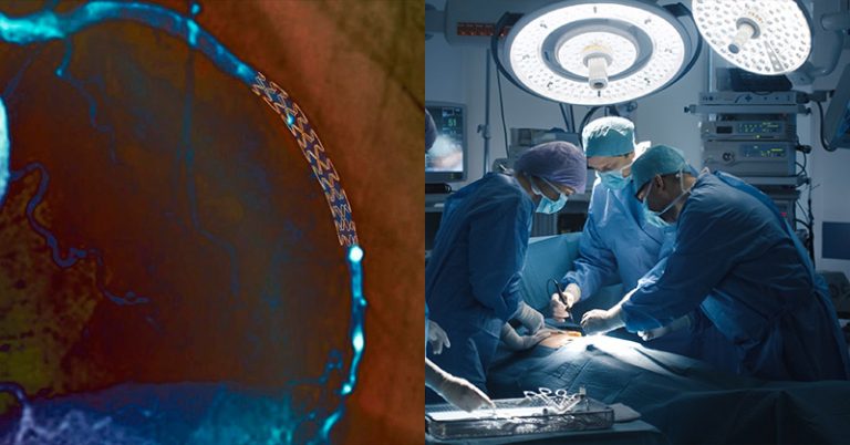 Surgery For Blocked Arteries Is Often Not Needed, Research Finds - Featured image