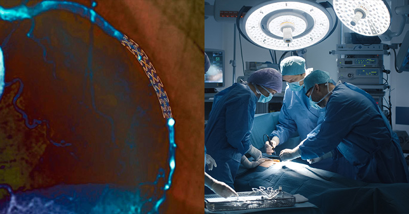 Surgery For Blocked Arteries Is Often Not Needed, Research Finds