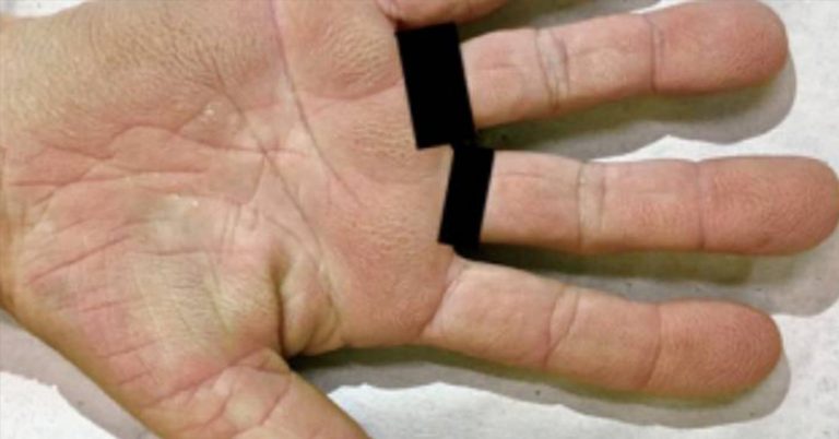 Woman’s Itchy, ‘Velvety’ Palms Turn Out to be Cancer Symptom - Featured image