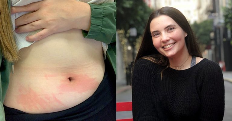 Student’s Allergy To Water Means She Can Only Shower Twice A Month - Featured image