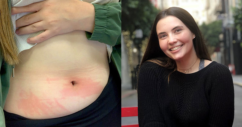 Student’s Allergy To Water Means She Can Only Shower Twice A Month