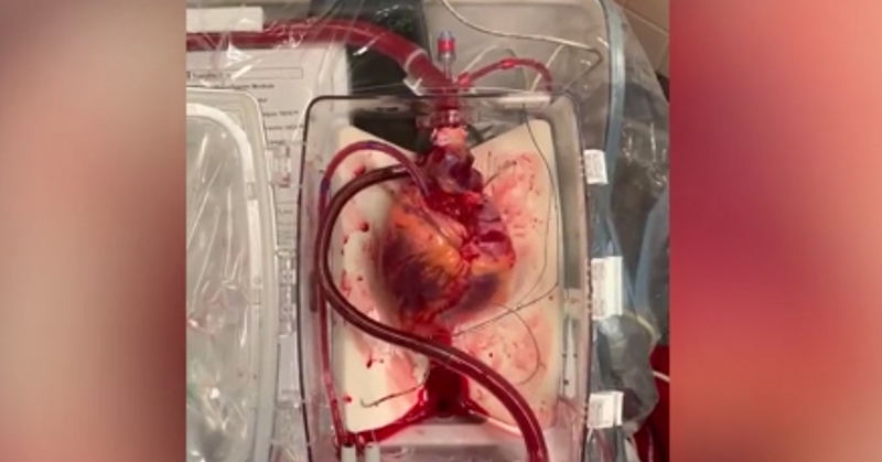 Doctors Brought Dead Heart ‘back to life’ For Groundbreaking Transplant