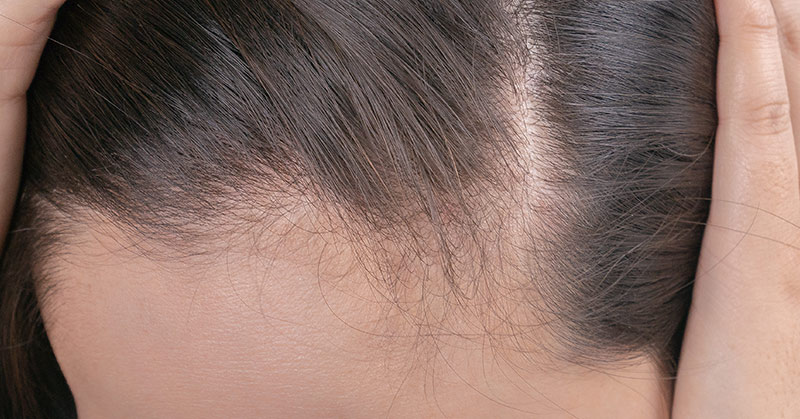 Natural Home Remedies for Hair Growth (Men and Women)