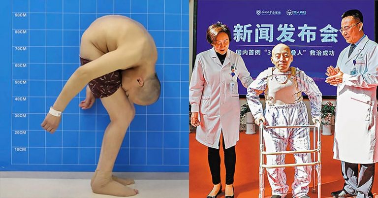 Man Folded In Half Stands Straight After 28 Years - Featured image
