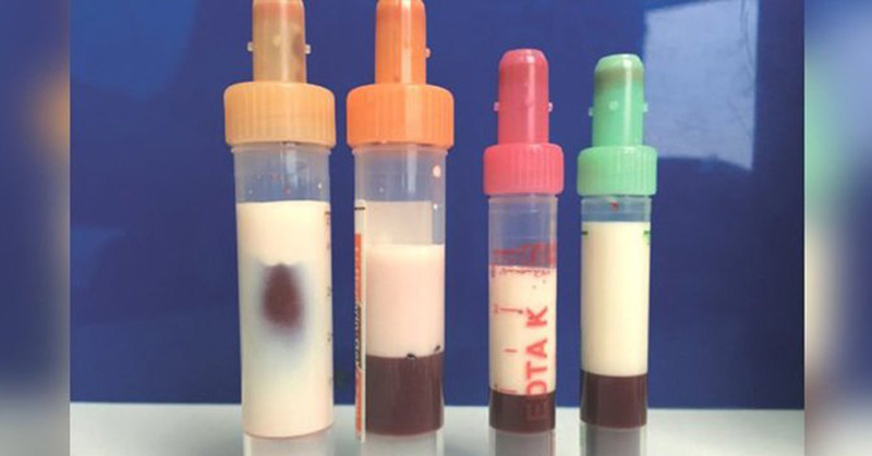 A Man’s Blood Was So Full of Fat, It Turned White And Almost Killed Him