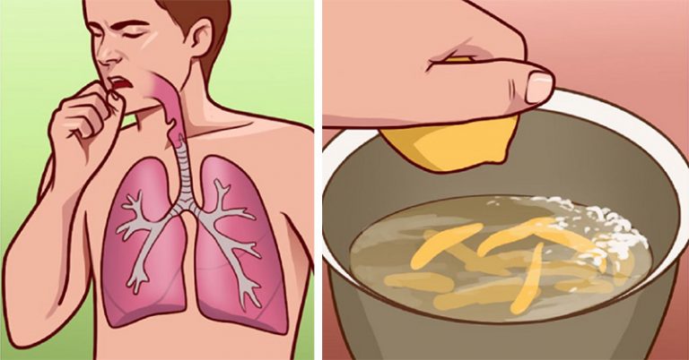 10 home remedies to help with bronchitis and painful coughing attacks - Featured image