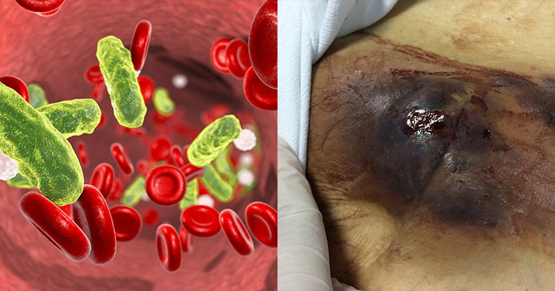 Sepsis Causes Far More Deaths Than Thought