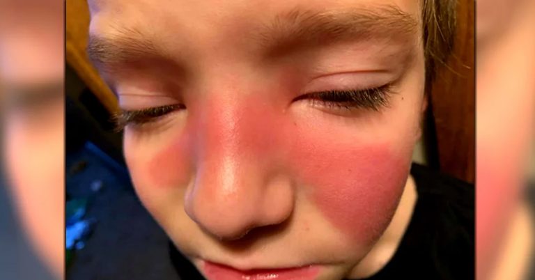 Parents Use Social Media To Warn Others of Strep in The Sinuses - Featured image