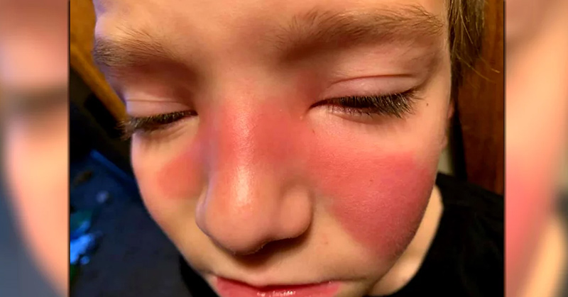 Parents Use Social Media To Warn Others of Strep in The Sinuses