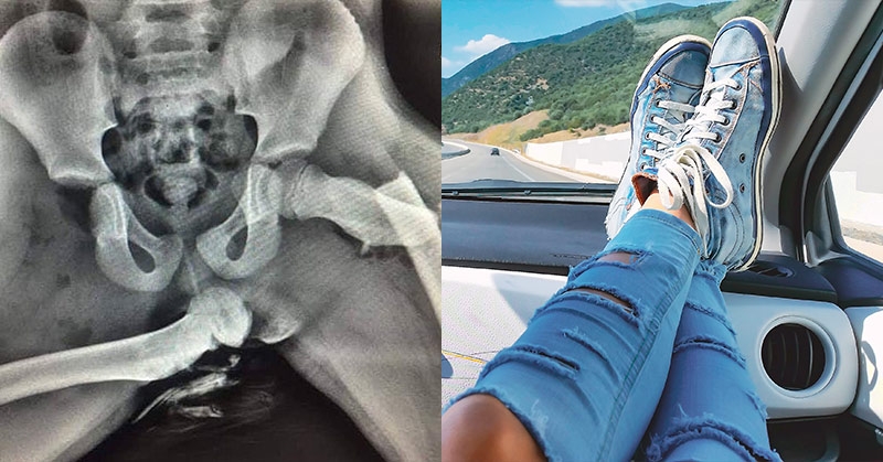 Woman’s hips are crushed in a crash after she propped her feet up on the dashboard