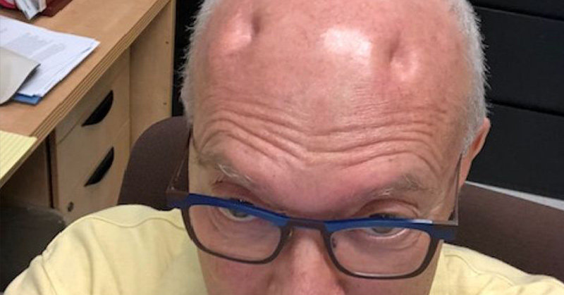 He Suddenly Had 4 Severe Dents Appear In His Head