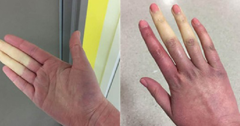 Rare Disorder Can Turn Fingers, Toes White or Blue When it’s Cold
