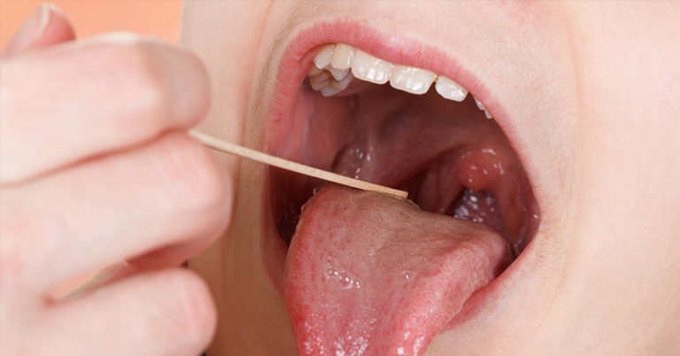 Have You Had Your Tonsils Removed? We May Have Some Bad News For You. - Featured image