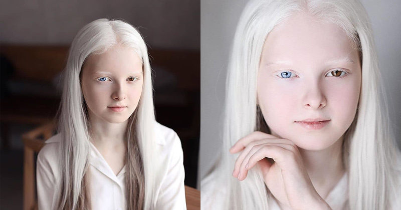 Ethereal Portraits Highlight the Unique Beauty of a Girl With Albinism and Heterochromia
