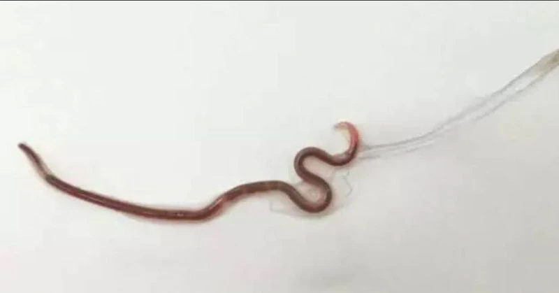 Doctors pull 1.5-inch worm from woman’s tonsils after she ate sashimi