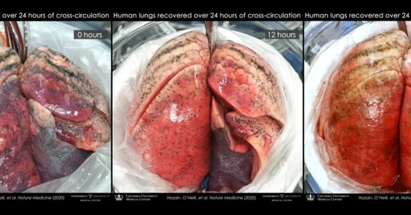 Damaged Human Lungs Can Be Repaired by Attaching Them to Pigs, Experiment Shows