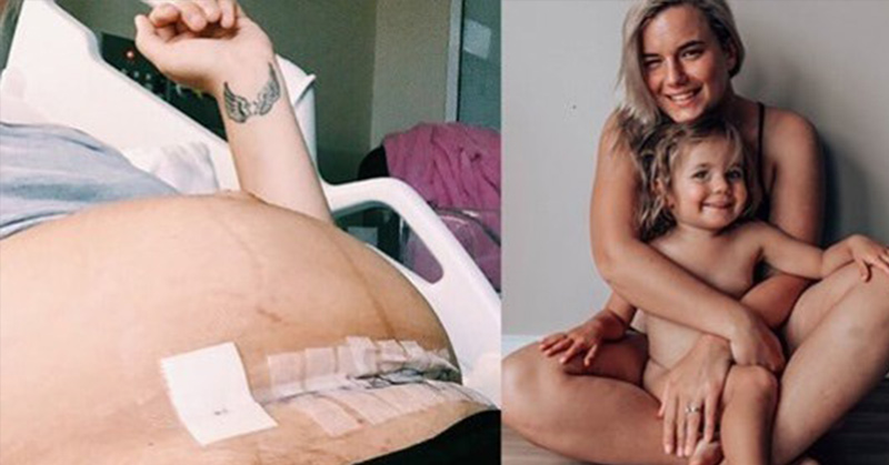 This Mom Just Schooled Anyone Who Thinks That A C-Section Is The ‘Easy Way Out’ - Featured image
