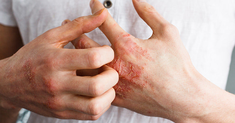 Scientists Are Figuring Out What Happens in The Skin When You Have Eczema