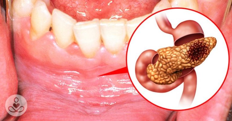 Massive 10-Year Study Links Gum Disease to Cancers, Major Health Problems - Featured image