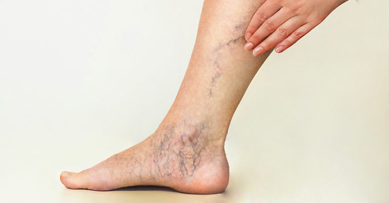 7 Exercises to Help Prevent Spider and Varicose Veins - Featured image
