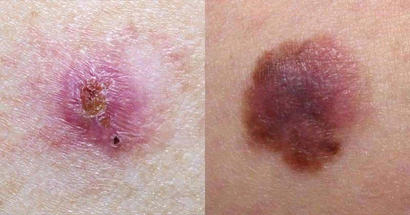These Close-Up Images Show Exactly What Different Types of Skin Cancer Look Like