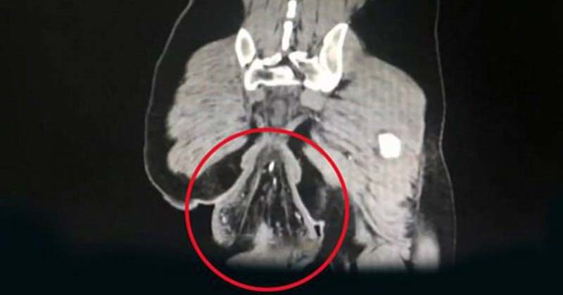 Man Suffers Rectal Prolapse After Playing Phone Games On Toilet