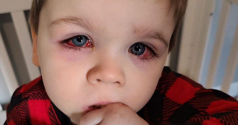 Boy Comes Dangerously Close To Losing Vision After Playing With Bath Toys, Mother Warns