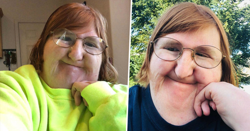 Woman With Bone Disorder Shares Selfie Everyday For a Year