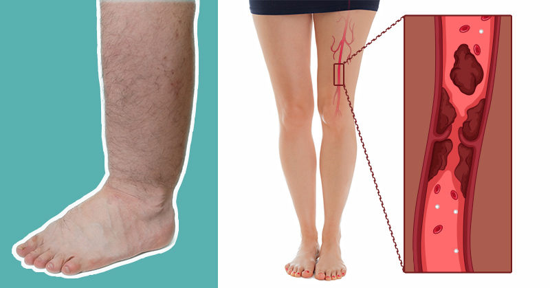 6 Warnings Your Body May Give When a Blood Clot Forms - Featured image