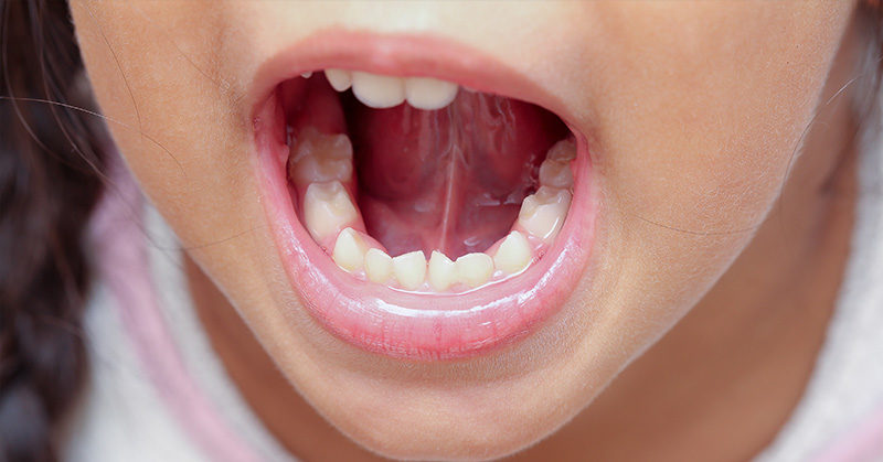 ‘Rapid evolution’ means humans now being born without wisdom teeth