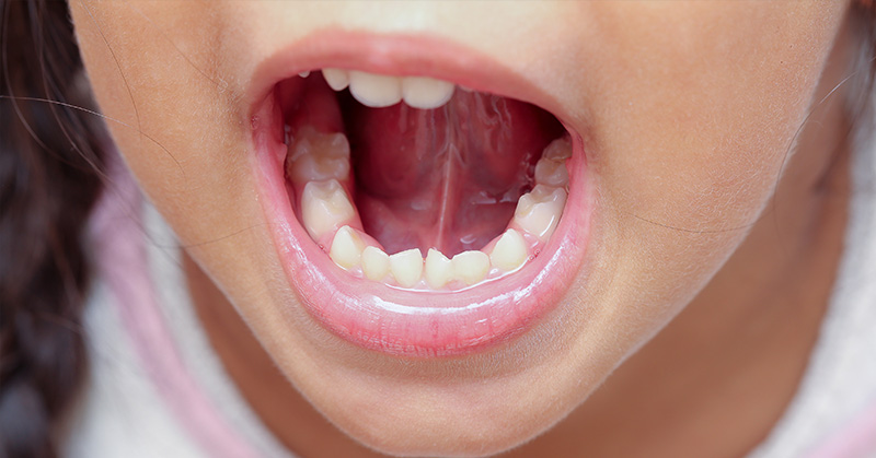 ‘Rapid evolution’ means humans now being born without wisdom teeth - Featured image