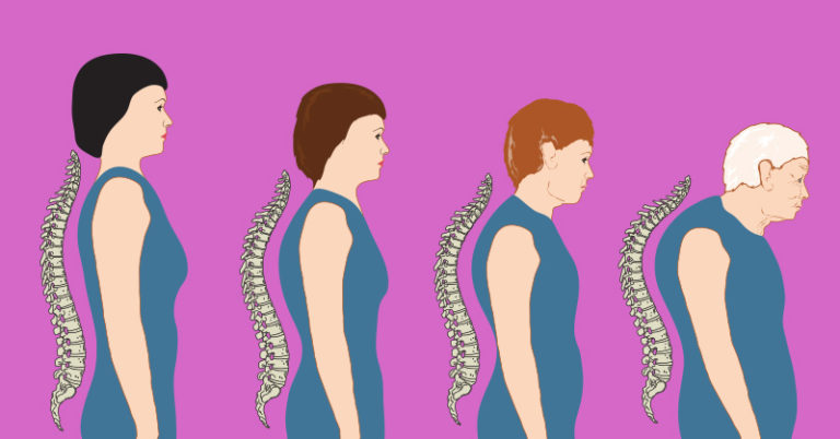 Your Bones Are Getting Weaker Year After Year, but There Are Ways to Keep Them Healthy - Featured image