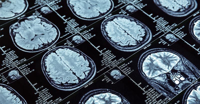 MS treatment a step closer after drug shown to repair nerve coating